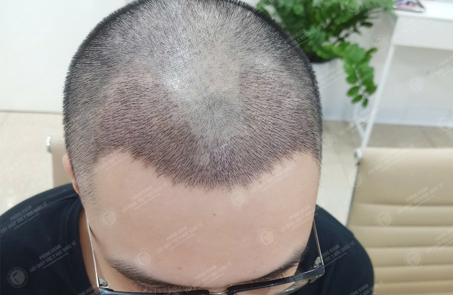 Nguyễn Thành Sơn - Cấy tóc đường chữ M 4