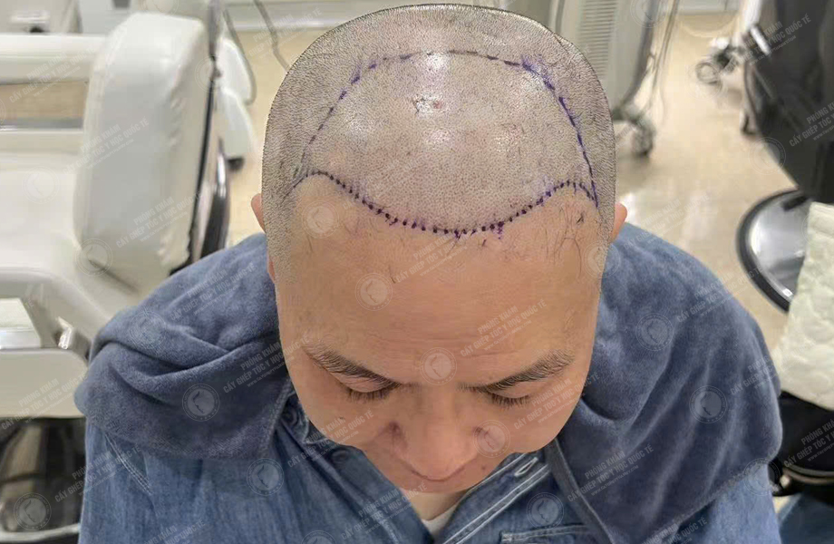 Lê Quý Sang - Cấy tóc đường chữ M 5