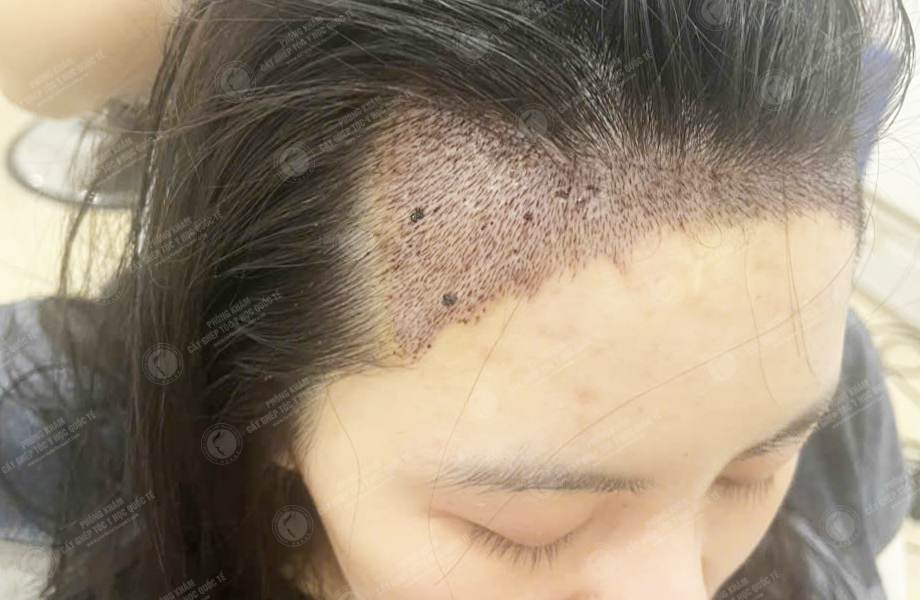 Nguyễn Huyền Linh - Cấy tóc đường chữ M 4