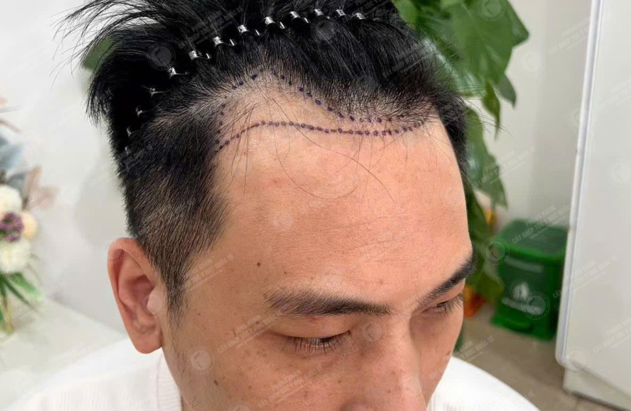Lê Tuấn Tùng - Cấy tóc đường chữ M 4