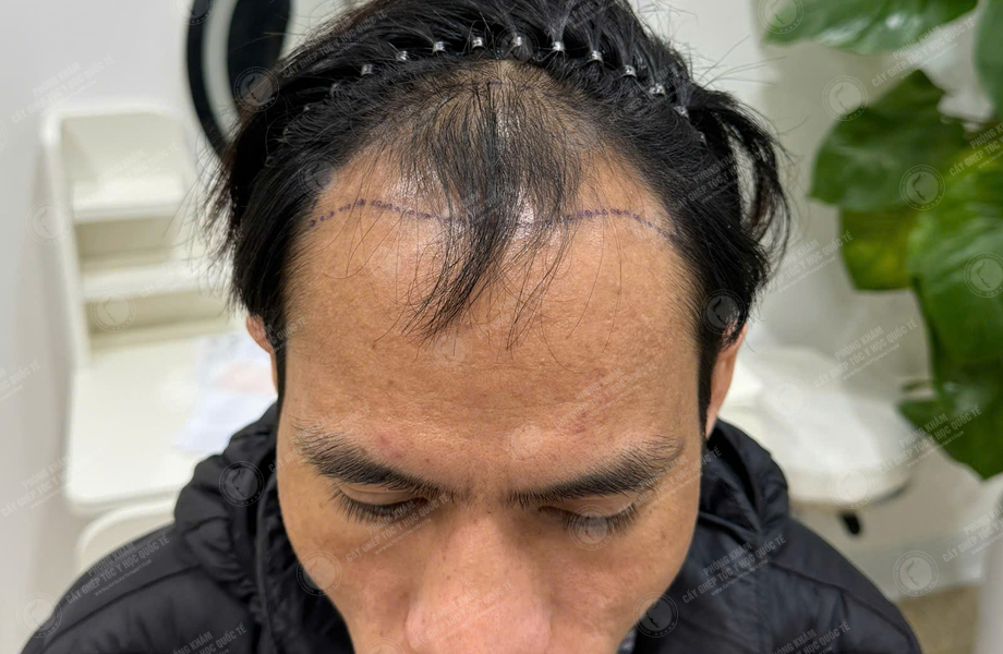 Nguyễn Đức Tâm - Cấy tóc đường chữ M 4