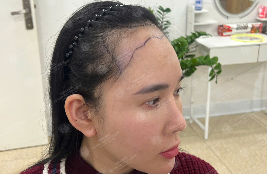 Nguyễn Tuyết Lan - Cấy tóc đường chữ M 4