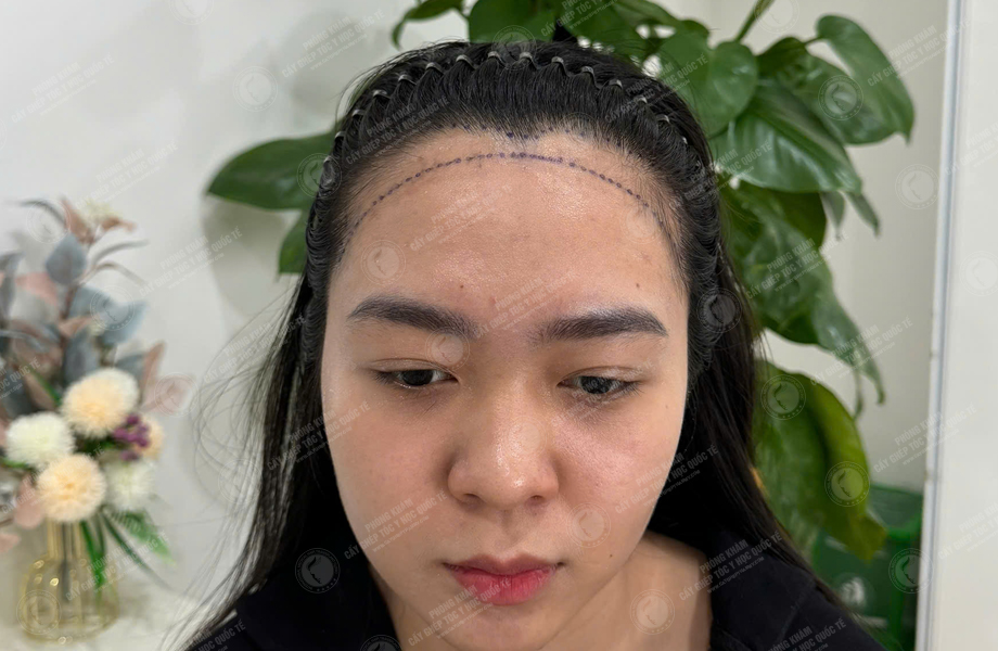 Nguyễn Hồng Hạnh - Cấy tóc đường chữ M 4