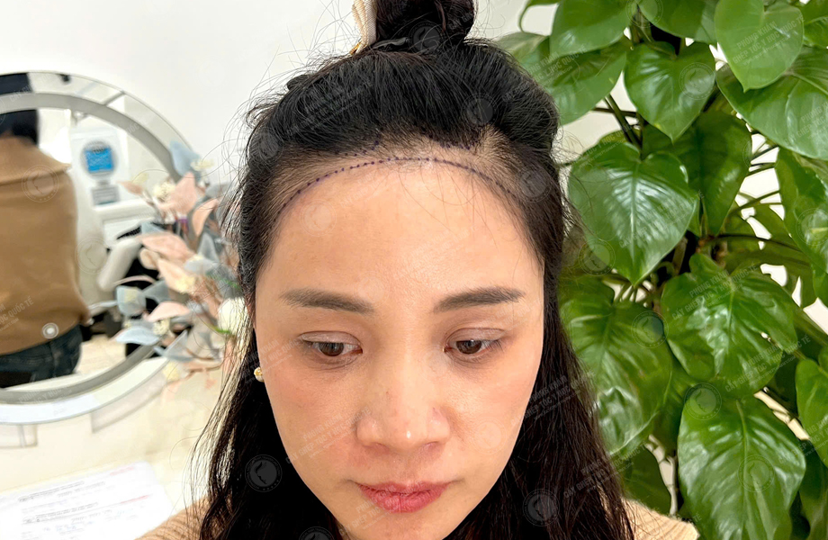 Lê Ánh Nguyệt - Cấy tóc đường chữ M 4