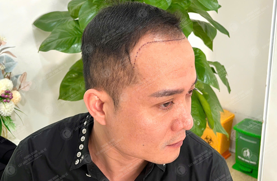 Trần Quốc Hoàn - Cấy tóc đường chữ M 4