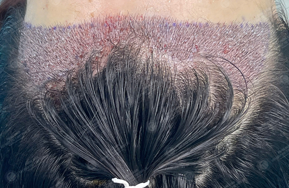 Nguyễn Mai Hoa - Cấy tóc đường chữ M 4