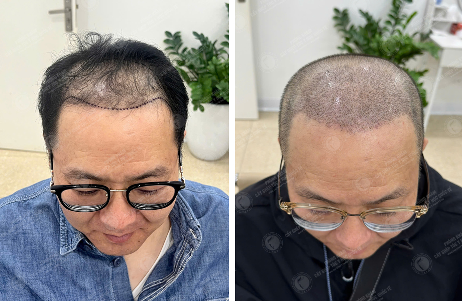  Lê Quý Sang - Cấy tóc đường chữ M 1