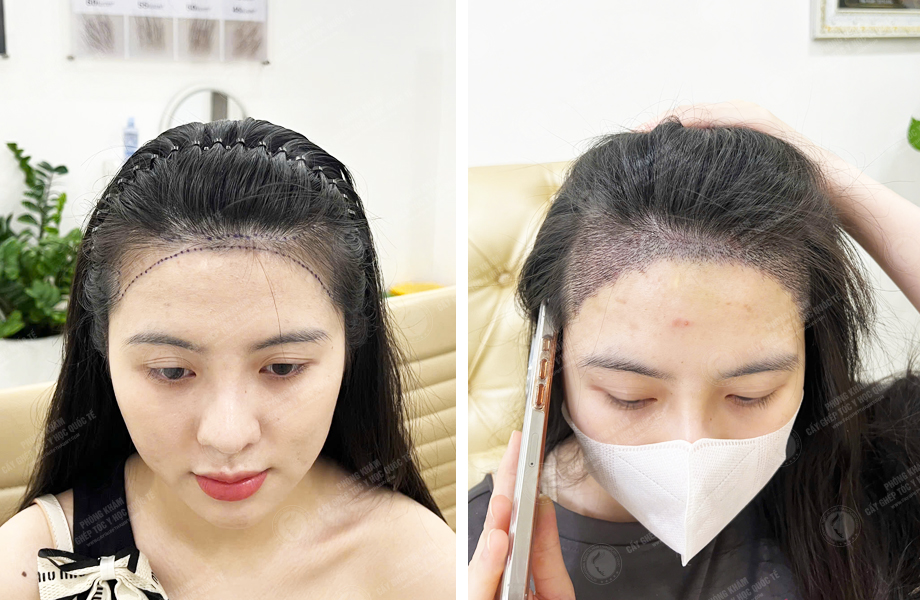  Nguyễn Huyền Linh - Điều chỉnh đường chân tóc 1