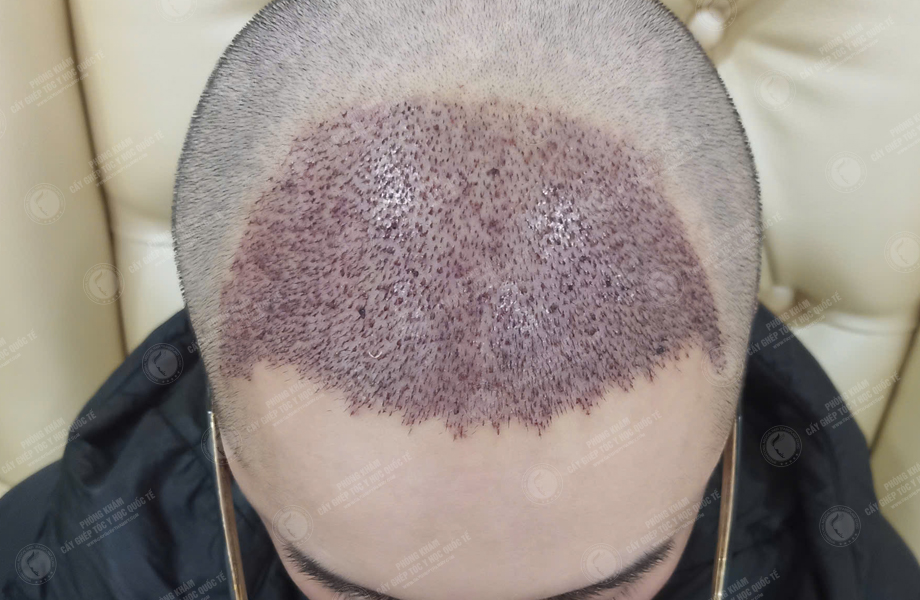 Bùi Văn Nguyên - Cấy tóc đường chữ M 5