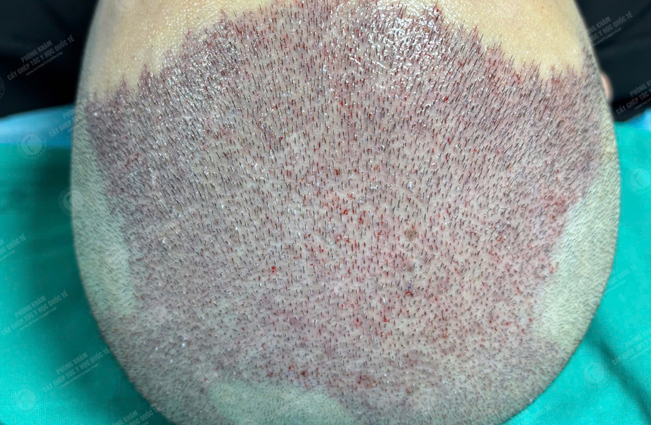 Nguyễn Hữu Cường - Cấy tóc đường chữ M 5