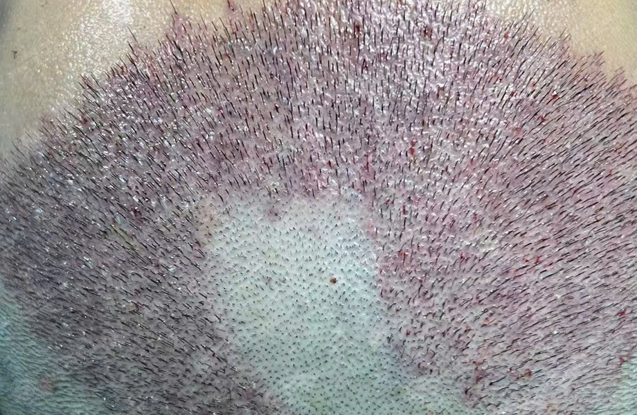 Lê Thanh Sơn - Cấy tóc đường chữ M 5