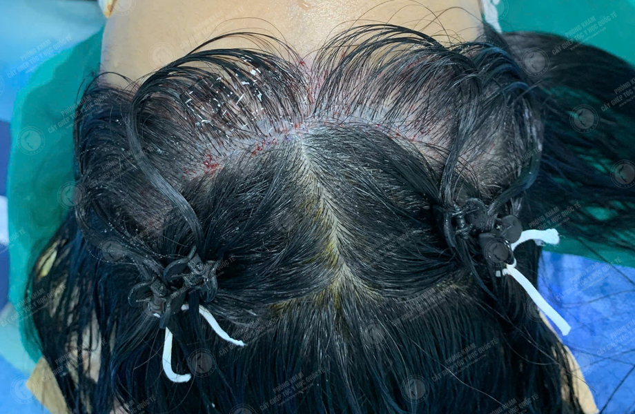 Trần Thị Huyền - Cấy tóc đường chữ M 5