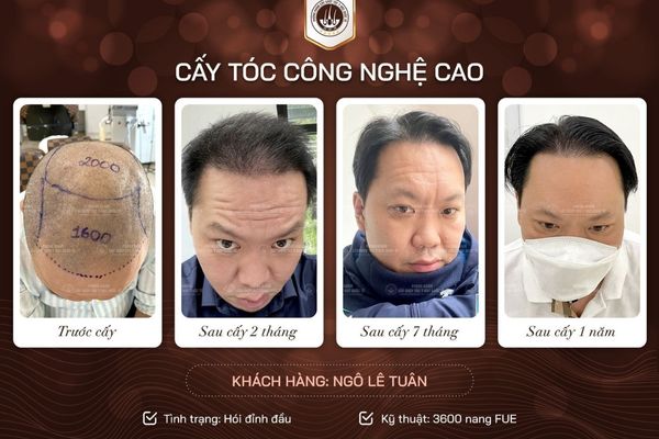 Bao lâu thì tóc cấy mới mọc lại? – Giải đáp chi tiết theo từng giai đoạn