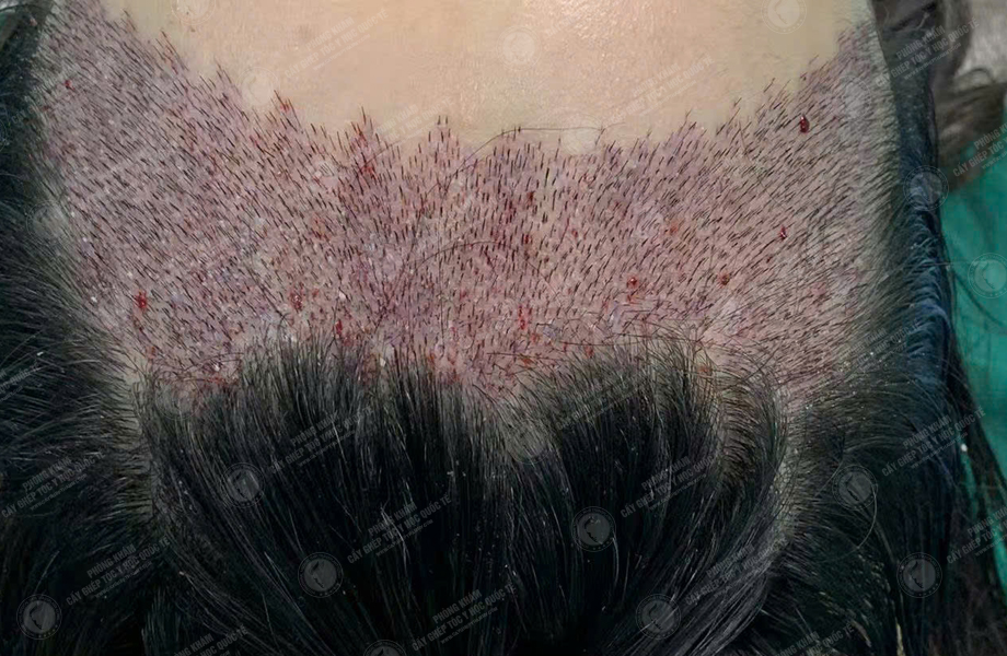 Trần Thị Hồng - Cấy tóc đường chữ M 5