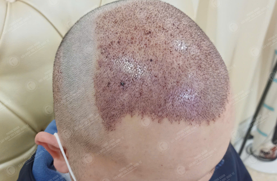 Hoàng Sơn Trung - Cấy tóc đường chữ M 5