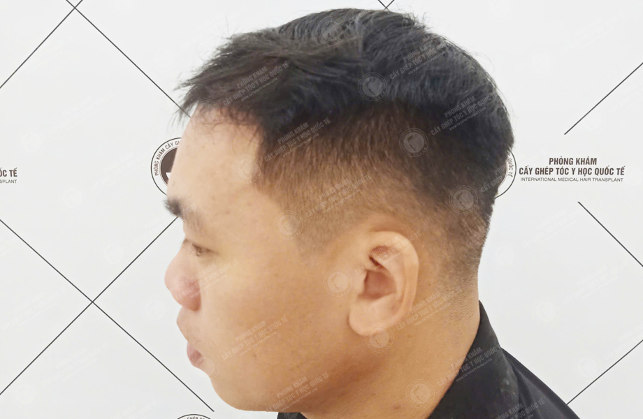 Trần Quốc Sơn - Cấy tóc đường chữ M 5