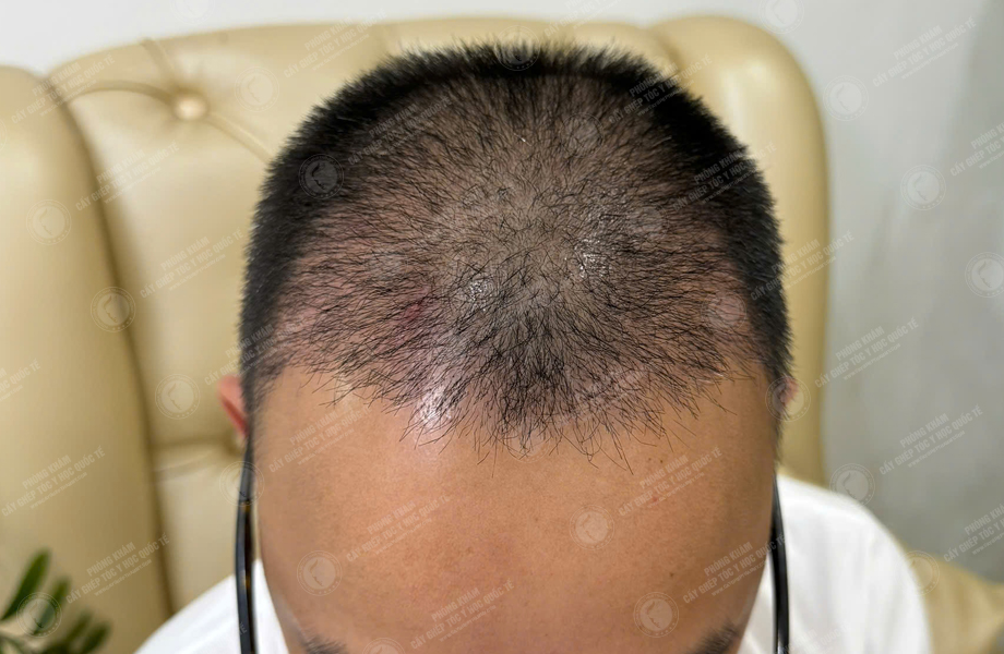 Lê Thanh Tùng - Cấy tóc đường chữ M 5