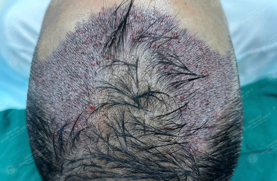 Phùng Thế Lữ - Cấy tóc đường chữ M 5