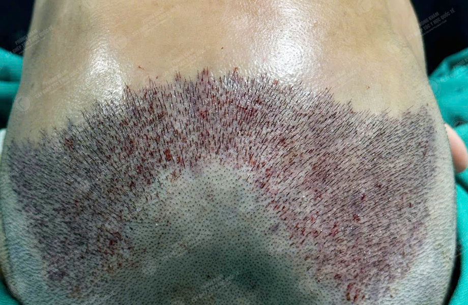 Nguyễn Tuấn Sơn - Cấy tóc đường chữ M 5