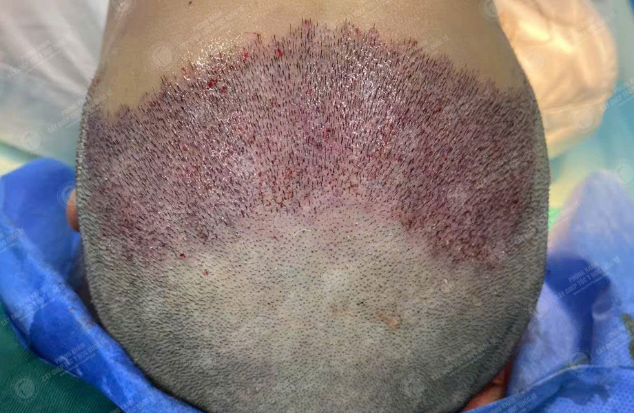 Trần Văn Nhất - Cấy tóc đường chữ M 5