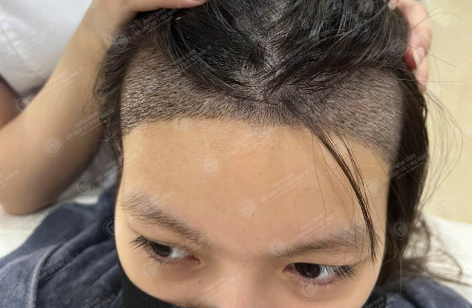 Lê Ngọc Linh - Cấy tóc đường chữ M 5