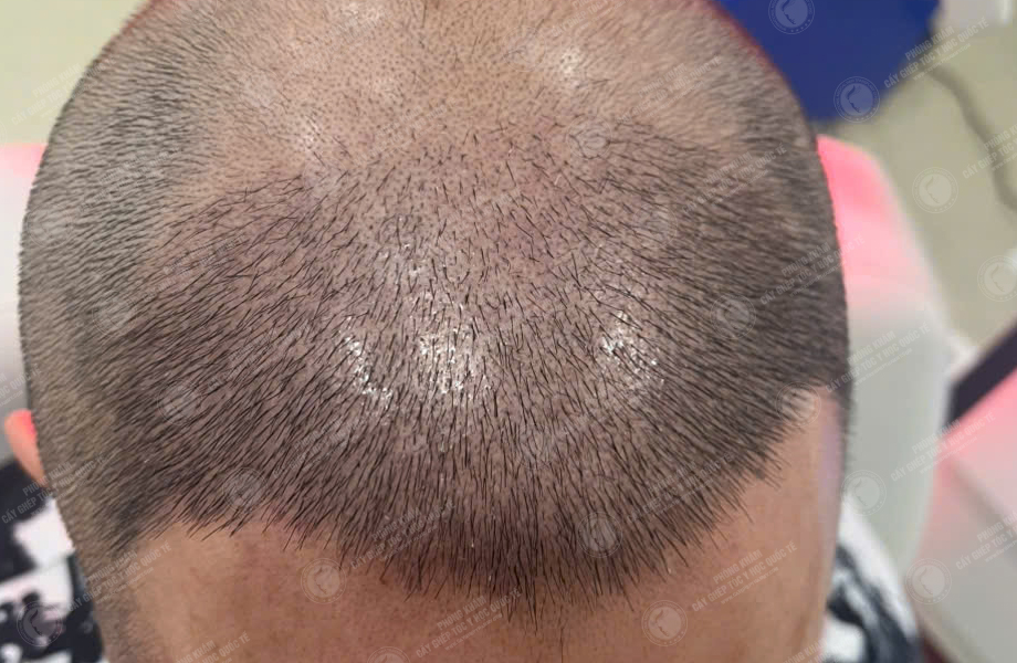 Trần Minh Linh - Cấy tóc đường chữ M 5