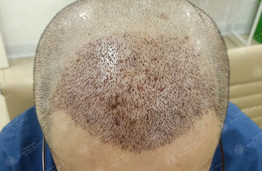 Lê Quý Sang - Cấy tóc đường chữ M 6