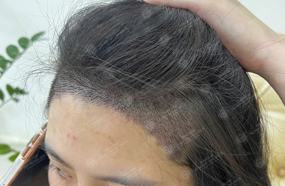 Nguyễn Huyền Linh - Cấy tóc đường chữ M 5