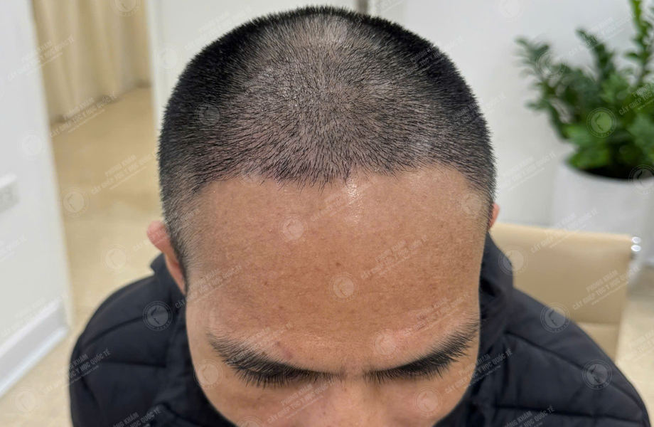 Nguyễn Đức Tâm - Cấy tóc đường chữ M 5