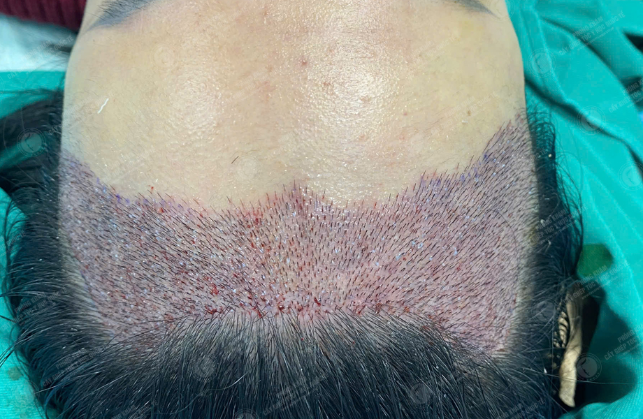 Nguyễn Tuyết Lan - Cấy tóc đường chữ M 5