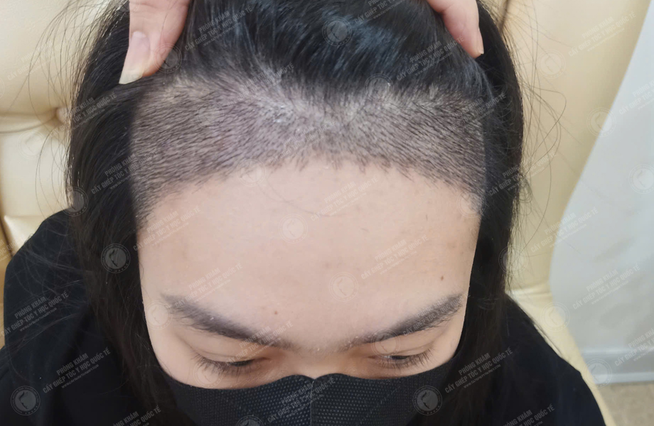 Nguyễn Hồng Hạnh - Cấy tóc đường chữ M 5