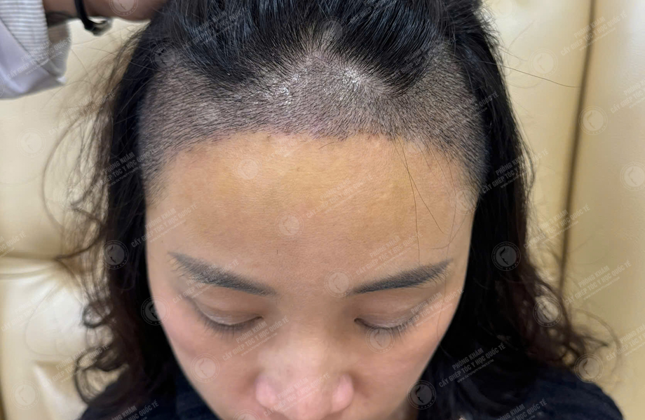 Lê Ánh Nguyệt - Cấy tóc đường chữ M 5