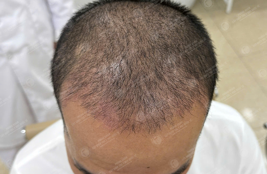 Trần Quốc Hoàn - Cấy tóc đường chữ M 5