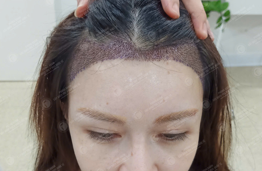 Nguyễn Mai Hoa - Cấy tóc đường chữ M 5