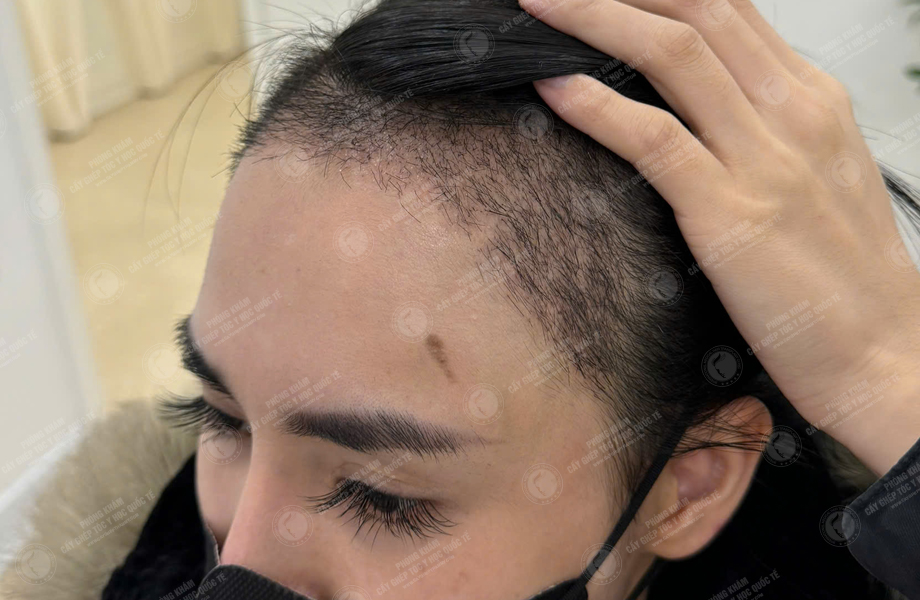 Nguyễn Tuyết Mai - Cấy tóc đường chữ M 6