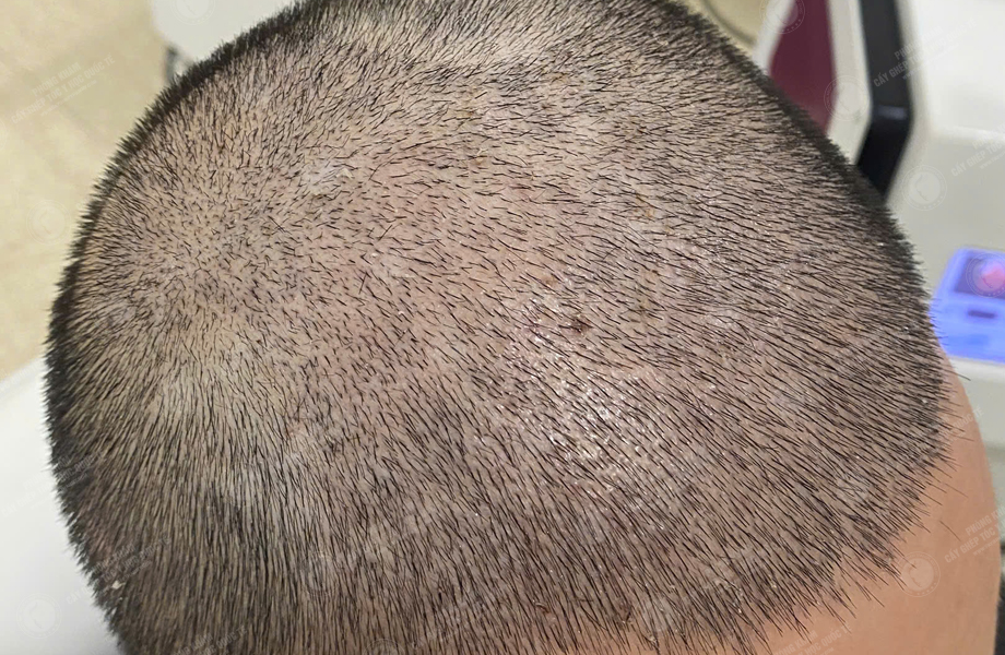 Nguyễn Hữu Cường - Cấy tóc đường chữ M 6