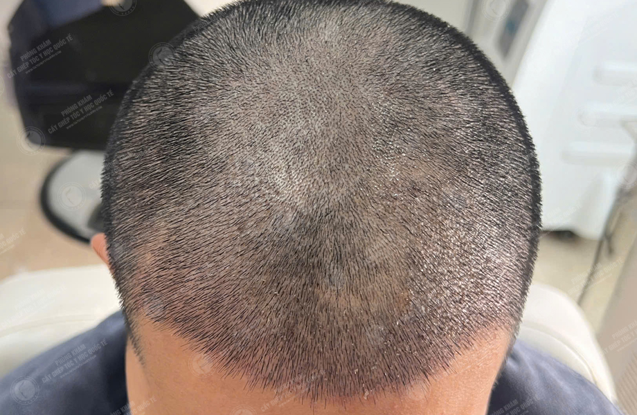 Lê Thanh Sơn - Cấy tóc đường chữ M 6