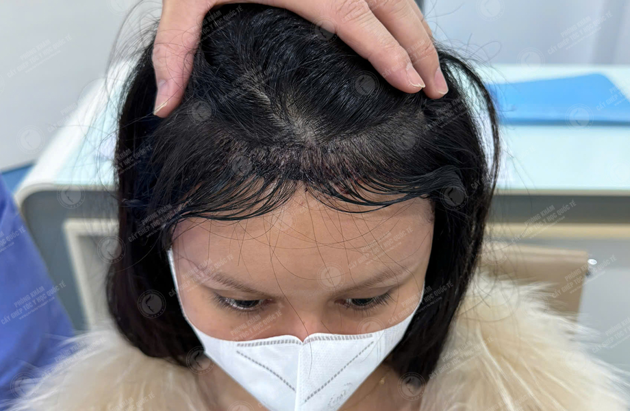 Trần Thị Huyền - Cấy tóc đường chữ M 6
