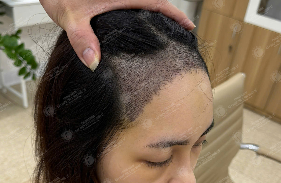 Trần Thị Hồng - Cấy tóc đường chữ M 6