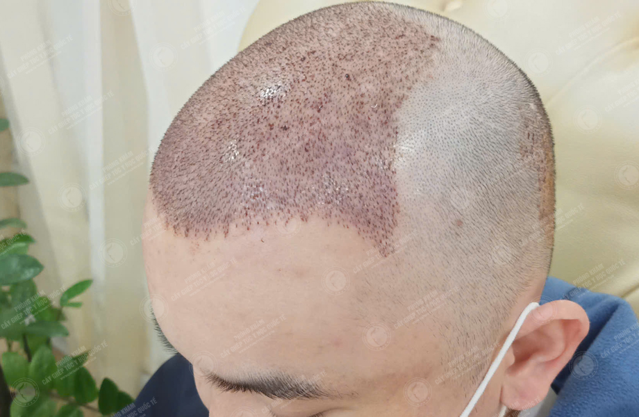 Hoàng Sơn Trung - Cấy tóc đường chữ M 6