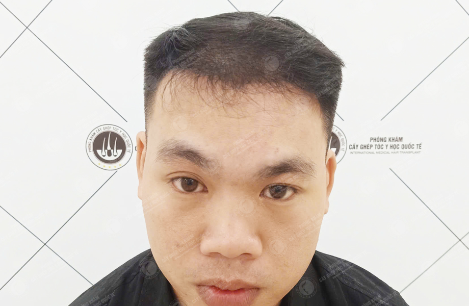 Trần Quốc Sơn - Cấy tóc đường chữ M 6