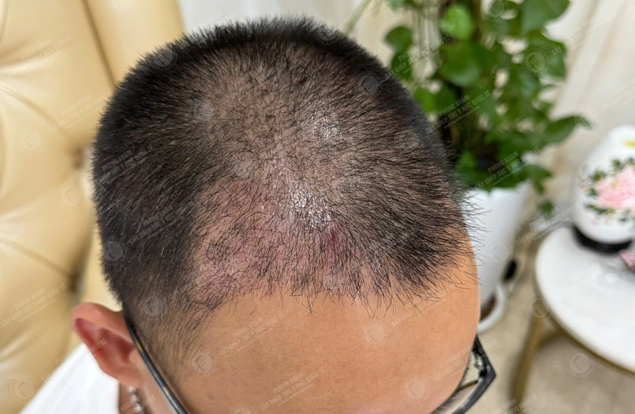 Lê Thanh Tùng - Cấy tóc đường chữ M 6