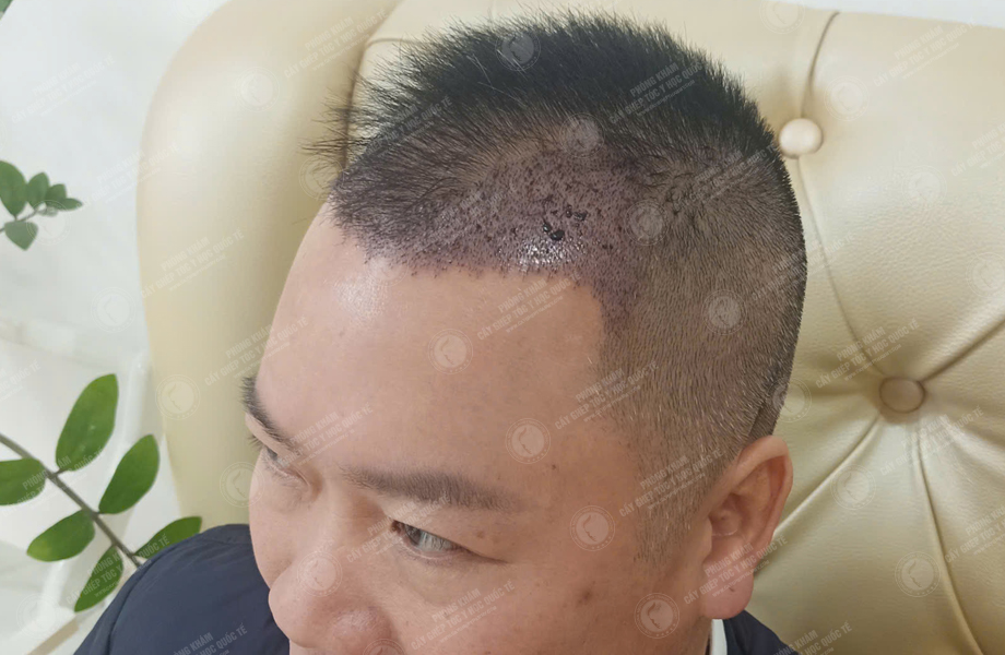 Phùng Thế Lữ - Cấy tóc đường chữ M 6