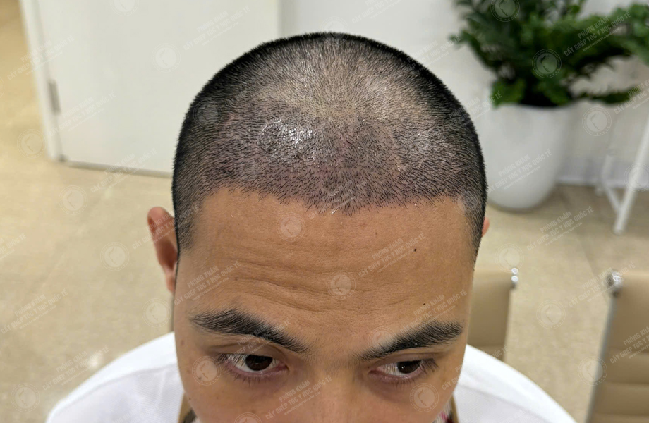 Trần Văn Nhất - Cấy tóc đường chữ M 6