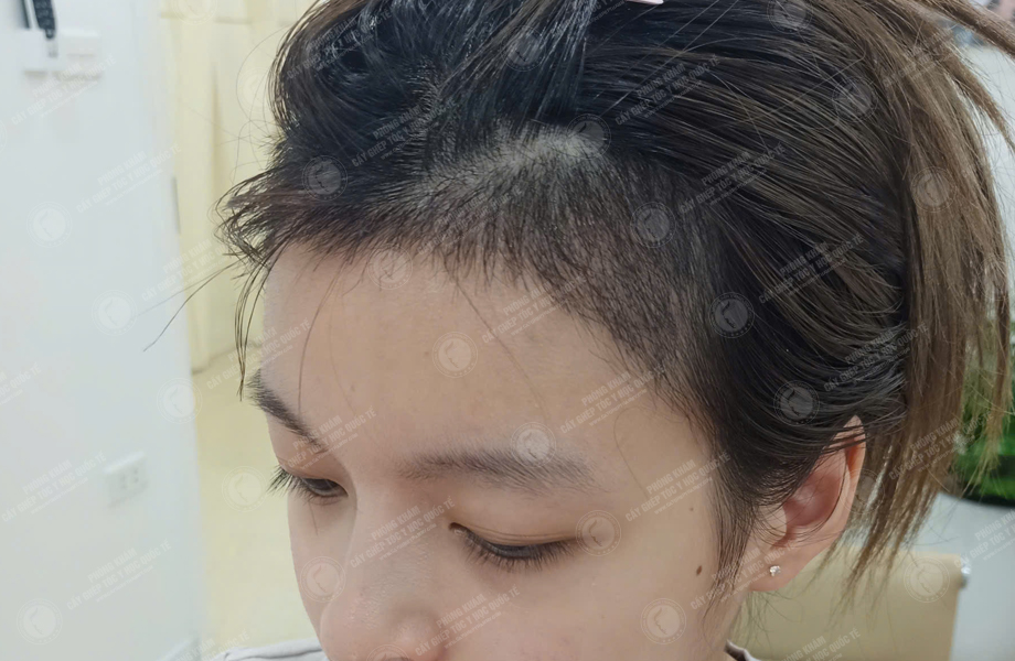 Lê Ngọc Linh - Cấy tóc đường chữ M 6