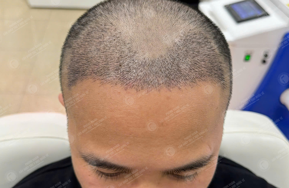 Nguyễn Tuấn Sơn - Cấy tóc đường chữ M 6