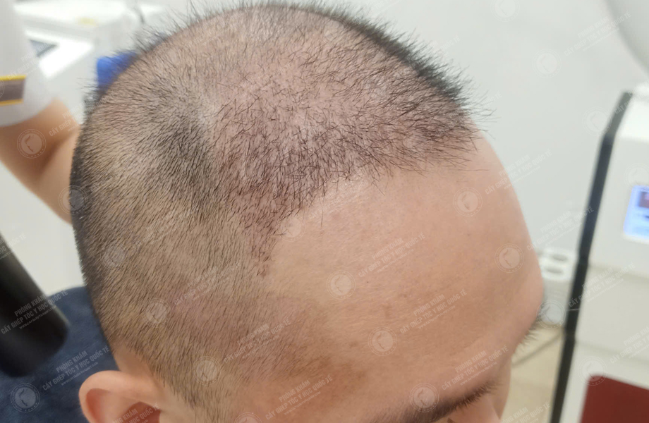 Trần Minh Linh - Cấy tóc đường chữ M 6