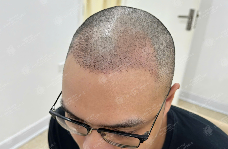 Nguyễn Thành Sơn - Cấy tóc đường chữ M 6