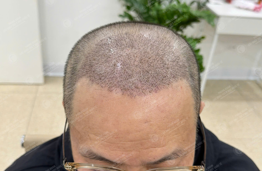 Lê Quý Sang - Cấy tóc đường chữ M 7