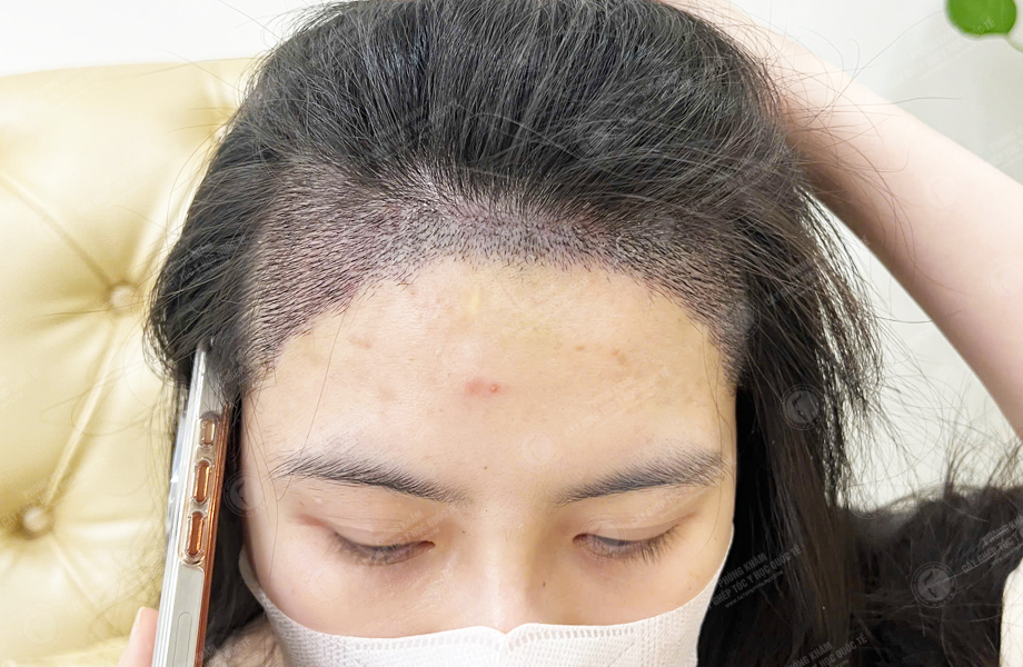 Nguyễn Huyền Linh - Cấy tóc đường chữ M 6